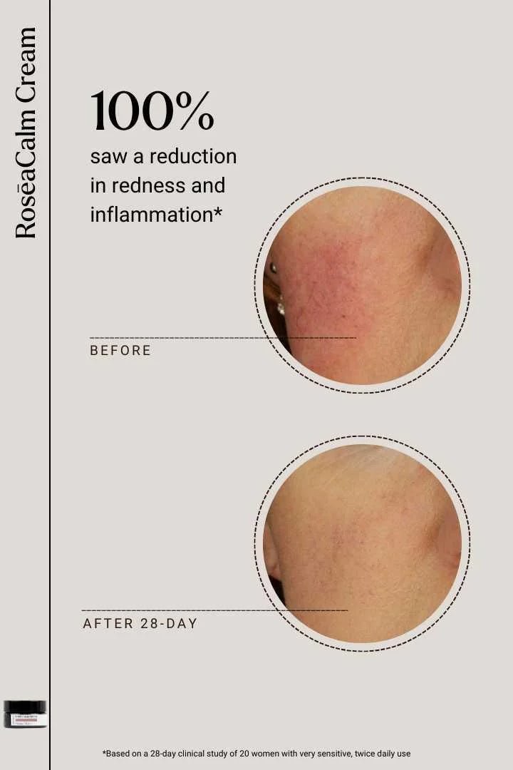 Naya Calm Me RosēaCalm Creme - Klinische Studie Vorher und Nachher