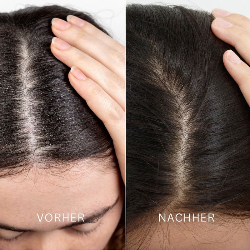 Noelie Scalp & Hair Detox Mask Vorher Nachher